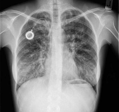 Still image from a video published online showing a dynamic chest radiograph acquired during tidal and deep breathing. Image courtesy of Radiology.