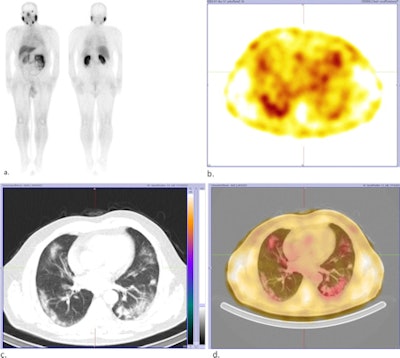 a) Whole-body Tc-99m PSMA study with faint uptake in the chest region as well as physiologic distribution of radiotracer. b) SPECT reveals mild peripheral Tc-99m PSMA uptake in the lung fields. c) CT shows multifocal, bilateral, and peripheral ground-glass opacities in lungs. d) Fused SPECT/CT shows the PSMA uptake is matched by ground-glass opacities in the lung (left lung COVID-related consolidation also shows the same uptake but is not apparent in this cut due to respiratory motion misregistration, the authors noted). Images courtesy of the Egyptian Journal of Radiology and Nuclear Medicine.
