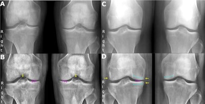 Examples of false-negative and false-positive findings by RBknee. Yellow arrows indicate osteophytes, solid purple vertical lines indicate joint space narrowing, and striped curved turquoise lines indicate subchondral sclerosis. The left column shows an 81-year-old man with prednisolone-treated polymyalgia rheumatica, referred for posterior-anterior, weight-bearing radiograph of both knees under indication of knee pain with unspecified laterality. (A) shows the original radiograph. (B) shows the same radiograph annotated by the AI tool. The radiology consultant consensus graded the right knee as Kellgren-Lawrence grade 2 while the artificial intelligence tool graded it as 0. They both graded the left knee as 2. Note that this is the only case where the artificial intelligence tool graded a knee 2 or more points lower than the consensus. The right column shows a 46-year-old woman referred for posterior-anterior, weight-bearing radiograph of both knees under indication of knee pain with unspecified laterality. (C) shows the original radiograph. (D) shows the same radiograph annotated by the artificial intelligence tool. The radiology consultant consensus graded the right knee as Kellgren-Lawrence 1 while the artificial intelligence tool graded it as 2. Notably, all readers except one consultant and one resident radiologist graded the knee as 2 or higher. Image courtesy of the European Journal of Radiology.