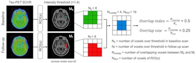 The overlap index was designed to identify voxels with stable high activity over time using two consecutive tau PET scans. Image courtesy of the Journal of Nuclear Medicine.