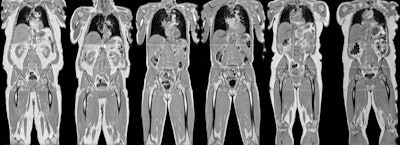 Examples of change in body mass index for three UK Biobank subjects. From left to right: -6.9, 0.0, and 4.4 kg/m2. Images courtesy of Brandon Whitcher and the UK Biobank.