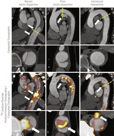 (Top) Longitudinal and (bottom) cross-sectional (yellow dashed line) aortic imaging at sites of dissection and hematoma (white arrows). Image courtesy of JACC: Cardiovascular Imaging.