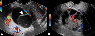 A multi-institutional research team found that pelvic ultrasound can be a good predictor of whether adnexal lesions will become ovarian cancer. (A) Transverse color Doppler image of right adnexa shows what's consistent with a nonclassic lesion without blood flow. This multilocular cystic lesion shows smooth septation and no Doppler flow. (B) Transverse color Doppler image of right adnexa is compatible with a nonclassic lesion with blood flow. It shows a multilocular cystic lesion with solid component and internal Doppler flow. Image courtesy of RSNA.