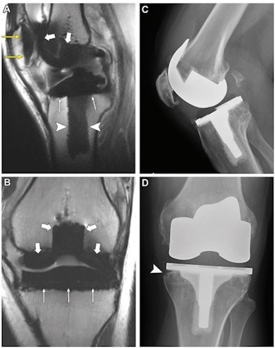 (A) Sagittal noncontrast-enhanced intermediate-weighted multiacquisition variable resonance imaging combination selective MRI scan (repetition time msec/echo time msec, 4000/7.9) in the midline knee and (B) coronal noncontrast-enhanced intermediate-weighted fast spin-echo MRI scan (4057/32) in the anterior knee in a 51-year-old man show normal interfaces along the patellar component (yellow arrows), femoral component (thick white arrows), and the tibial component, including the tibial tray (thin white arrows) and the keel (arrowheads). (C) Lateral and (D) anteroposterior radiographs in the same knee show normal appearance of the components except for minor bone resorption along the medial tibial tray (arrowhead). Images and caption courtesy of the RSNA.