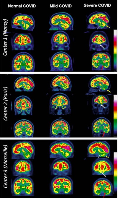 Typical examples of brain F-18 FDG-PET images of patients with suspected long COVID in three French nuclear medicine departments, all presenting positive RT-PCR and/or serology tests. In patients with a typical severe long-COVID hypometabolic pattern, the brain areas with hypometabolism are identified with arrows: white arrows for the fronto-orbital olfactory regions, red arrows for the other limbic/paralimbic regions, grey arrows for the pons, and yellow arrows for the cerebellum. Image courtesy of the European Journal of Nuclear Medicine and Molecular Imaging.