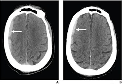 76-year-old patient, not on antithrombotic therapy, presenting to emergency department after ground-level fall (Glasgow Coma Scale of 15). Patient had no focal neurological deficit. (A) Axial slice from initial noncontrast head CT shows right frontoparietal subdural hematoma (arrow); hematoma was classified as exhibiting both regional mass effect and midline shift (not shown). (B) Axial slice from noncontrast head CT performed eight hours later shows stable size of hematoma (arrow). Patient was discharged home in stable condition two days later. Images and caption courtesy of the American Roentgen Ray Society.