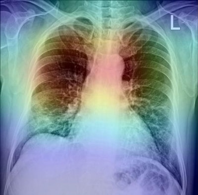 An AI model's decision area visualized on a chest x-ray heat map. Image courtesy of Radiography.