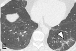 2022 03 29 21 01 9954 2022 03 30 Lung Ct Covid Figure4 400