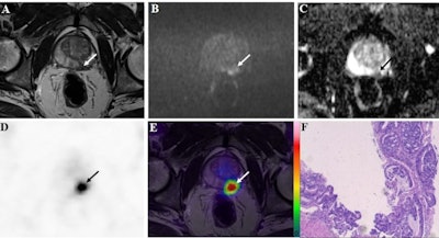 A 72-year-old patient with a prostate-specific antigen (PSA) level of 50.8 ng/ml. The lesion with tumor diameter of 11.7 mm (arrow) was evaluated as positive (PI-RADS score 4) on bpMRI with T2WI image (A), DWI image (B), and ADC map (C), indicating prostate cancer lesion. On F-18 PSMA-1007 PET image (D), the lesion showed intense uptake with an SUVmax of 79.6 (PSMA-RADS score 5). Combined with bpMRI and PET score, fused F-18 PSMA-1007 PET/MRI image (E) further suggested prostate cancer. Subsequent biopsy results (F) proved prostate cancer lesion of ISUP grade 5 with Gleason score 5+4. Image courtesy of Prostate International.