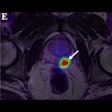 2022 03 30 17 58 0064 2022 03 31 Pet Mri Prostate Cancer Image E 400