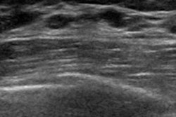 2019 07 12 00 07 3354 Breast Ultrasound 400