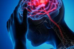 2021 04 22 23 05 5088 Brain Stroke 400