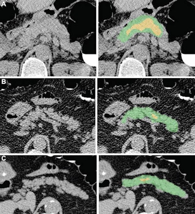 Examples of pancreas segmentations on unenhanced axial abdominal CT images in healthy participants and patients with type 2 diabetes mellitus. Images on left are original CT images, and images on right show segmentations overlaid on the original CT images. (A) Images in a nondiabetic 61-year-old man with average pancreas CT attenuation of 35.50 HU ± 47.96 and pancreatic volume of 97.6 mL. (B) Images of a 59-year-old man with type 2 diabetes who was diagnosed 144 days before CT. Average pancreas CT attenuation was 20.66 HU ± 81.99 and pancreatic volume was 77.10 mL. (C) Images in a 67-year-old man with type 2 diabetes who was diagnosed 595 days after CT. Average pancreas CT attenuation was 18.46 HU ± 48.30 and pancreatic volume was 72.88 mL. The green area indicates full segmentation and the yellow area indicates segmentation after erosion. Image and caption courtesy of the RSNA.