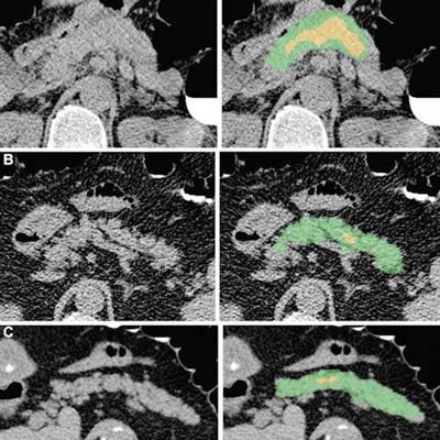 2022 04 04 23 42 0588 2022 04 05 Radiology Ai Diabetes 20220404231435