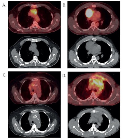 Panel A and B demonstrate resectable disease. Panel C and D demonstrate unresectable disease that would benefit from systemic therapy. Panel A demonstrates a thymoma that appears suitable for resection on PET/CT imaging (above) and CT imaging (below). Panel B demonstrates a resectable lymphoma on PET/CT imaging (above) and CT imaging (below). Panel C demonstrates an unresectable thymoma on PET/CT imaging (above) and CT imaging (below). This thymoma is unresectable given invasion of the mass into the great vessels. Stents were placed prior to imaging to relieve compression by the mass. Panel D demonstrates an unresectable lymphoma on PET/CT imaging (above) and CT imaging (below). This lymphoma is unresectable given the direct extension of the tumor into the ribs and surrounding muscle. Image courtesy of the Journal of Thoracic and Cardiovascular Surgery.