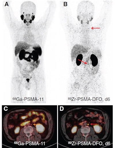 Ga-68 PSMA-11 PET with maximum intensity projection (MIP) (A) and PET/low-dose CT fusion images (C), and Zr-89 PSMA-DFO PET six days after injection with MIP (B) and PET/low-dose CT fusion images (D) of a patient with biochemical recurrence after prostatectomy and stereotactic radiation therapy. Images are highly suggestive of PSMA-positive lymph node metastases supraclavicular left and retroperitoneal left, visible with Zr-89 PSMA-DFO (red arrows in B and D). Lymph nodes were PSMA-negative with Ga-68 PSMA-11 (yellow arrow in C). Patient underwent SRT and temporary ADT and PSA level dropped to 0.17 ng/mL. Image courtesy of Journal of Nuclear Medicine.
