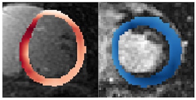 After analyzing raw MR images, a deep-learning algorithm can predict if and when a patient will have a lethal episode of heart arrhythmia. The algorithm detected high risk in the heart circled in red. Image courtesy of Johns Hopkins University.