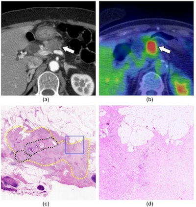 A 71-year-old woman with pancreatic ductal adenocarcinoma, shown as a representative case of the response group. (a) A contrast-enhanced CT image (pancreatic parenchymal phase) shows a hypoattenuating mass at the body of the pancreas (arrow). (b) An FDG-PET/CT image shows FDG uptake in the mass (arrow, SUVmax = 9.43). (c) A loupe view using hematoxylin and eosin staining shows the cancer remnant area (yellow dotted circles). A relatively dense area of residual cancer cells is observed in the center of the tumor (black dotted circles). Most of the periphery of the tumor is covered with fibrosis. (d) A low magnification view (×40) using hematoxylin and eosin staining, which corresponds to the blue square in (c), shows the presence of a few cancer cells and extensive fibrosis (grade 2). Image courtesy of Clinical Radiology.