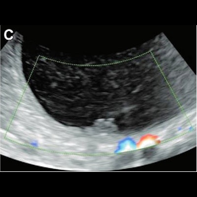 2022 04 12 18 51 7947 2022 04 14 Radiology Deep Learning Ovarian Ultrasound 400