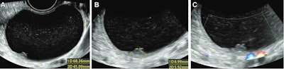 Ultrasound images in 36-year-old woman show a unilocular cyst with a solid component in the right ovary, diagnosed pathologically as a serous cystadenofibroma. (A) Grayscale ultrasound shows the maximal size plane of the mass. (B) Grayscale ultrasound shows the maximal size of the solid component. (C) Color Doppler ultrasound shows the solid component (score 1). This was misdiagnosed by using the Ovarian-Adnexal Reporting and Data System (O-RADS), while both deep-learning models and expert assessment were correct. Images courtesy of the RSNA.