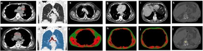 (A) Axial CT image shows coronary artery calcium (red square). (B) Axial CT image shows pulmonary artery and ascending aorta diameter at level of main pulmonary artery (red arrows). Coronal CT images (C) without and (D) with segmentation label map for lung densitometry to assess emphysema; label map shows lung parenchyma in blue and major airways in red. Axial CT images (E) without and (F) segmentation label map at level of fifth thoracic vertebral body, (G) without and (H) with segmentation label map at level of eighth thoracic vertebral body, and (I) without and (J) with segmentation label map at level of tenth vertebral body, for body composition analysis. Skeletal muscle in red; adipose tissue in green. Axial CT images (K) without and (L) with bone mineral density measurement, depicted by yellow ROI at first lumbar vertebral body. Images and caption courtesy of the ARRS.