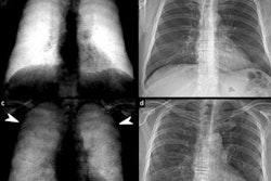 2022 04 13 23 07 3022 2022 04 14 Dark Field X Ray Covid 19 20220413234807