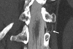 2022 04 18 17 43 5921 2022 04 18 Csf Venous Fistula 20220418175506