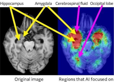 Fujifilm is touting the performance of its AI Technology for Alzheimer's Disease Progression Prediction technology, which uses 3D MR and CT images. The left image is the original brain image while the right image shows the regions AI focused on. Image courtesy of Fujifilm.