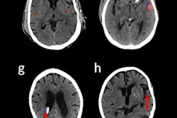 2022 04 20 23 25 4266 2022 04 21 Ct Ai Hemorhhage Figure4 400