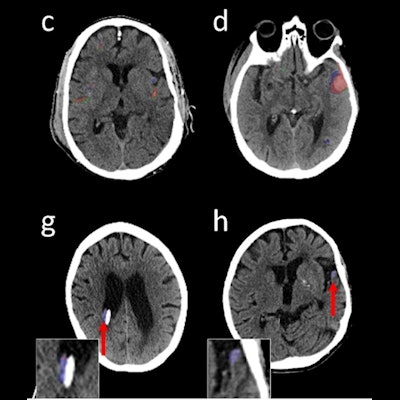 Subarachnoid hemorrhage  Radiology Reference Article