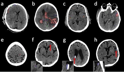 Illustrative head noncontrast CT axial images with predicted and reference segmentations; red shows true-positive, blue shows false-negative, and green shows false-positive voxels. (A-E) are high-confidence true-positive studies, (F) and (G) are low-confidence true-positive studies and (H) is a low-confidence false-negative result. Arrows and insets are shown for (F-H) to improve visibility of the overlays. The shunt adjacent and medial to the hemorrhage in (F) and the head tilt in (G) may have affected the confidence scores. Images and caption courtesy of the RSNA.