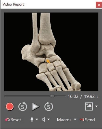 A team at New York University led the development of radiology video reports to help patients better understand imaging results. This screenshot shows some components of a video report, such as buttons to start, pause, stop recording, and rewind. The arrow points to a calcaneonavicular coalition on a cinematically rendered image. Image courtesy of the American Journal of Roentgenology.