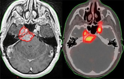 Patient Z is a female with a history of a grade 1 petroclival meningioma who was found to have progression on her most recent MRI brain scan with an increase in size from 3 x 1.5 cm to 3.4 x 1.4 cm. There was separate uptake on PET within the region of the left temporal lobe, which could relate to extension of the primary mass or separate focus of tumor. She was planned for 54 Gy of radiation in 30 fractions. Image courtesy of the International Journal of Radiation, Oncology, Biology, Physics.