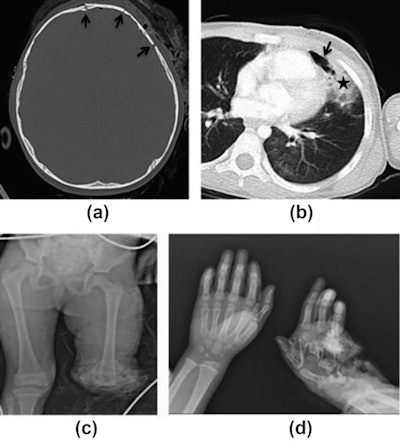 CT and radiography images of a 4-year-old girl with primary blast injury. CT images show multiple skull fractures (black arrows) in the cranium (a) and areas of pneumothorax (black arrow) and contusion (black star) in the left lung (b). (c,d) Radiographs of the same patient show left lower extremity and left hand fifth finger amputation, carpal bone fractures, and tissue defects. Image courtesy of Clinical Radiology.