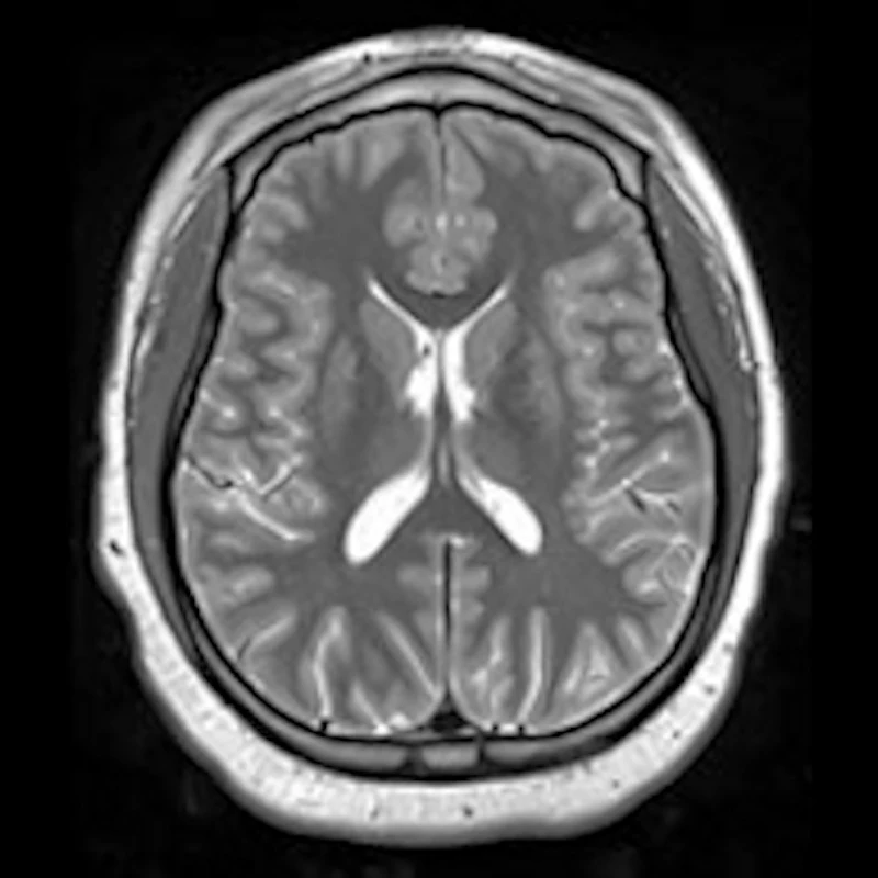 MRI illuminates brain structure abnormalities in premature babies ...