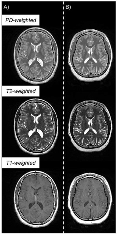 Example of triple turbo spin-echo brain MRI scans in (A) neurotypically developing and (B) atypically developing extremely preterm-born adolescents. Proton density (PD)-weighted, T2-weighted, and T1-weighted images are provided. MRI scans in the atypically developing participant (full-scale intelligence quotient < 85) demonstrated qualitatively smaller white and gray matter volumes and nearly indistinguishable tissue contrast compared with the neurotypically developing participant. Images and caption courtesy of the RSNA.