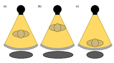 Figure 2. The gray circle at the bottom represents patient size when (a) the patient is centered at the gantry (b) an anterior shift is present in patient positioning (c) a posterior shift is present in patient positioning. Reproduced from Barreto et al.5