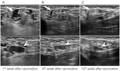 Ultrasound images of a 43-year-old asymptomatic woman without breast cancer show unilateral left axillary adenopathy after mRNA COVID-19 vaccination. (A) Images of the left axilla show enlarged lymph nodes with the cortex measuring up to 7.7 mm within the first week of BNT162b2 vaccination. (B.) Follow-up ultrasound images within six weeks (B) and (C) 12 weeks show decreased axillary lymphadenopathy of variable degrees, with the cortex measuring up to 5.7 and 3.4 mm, respectively. Image courtesy of the RSNA.