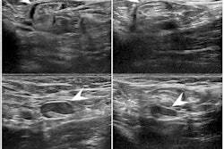 2022 04 26 23 57 7195 2022 04 26 Radiology Ultrasound Lymphadenopathy 400