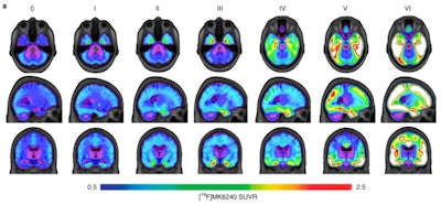 Average F-18 MK-6240 SUVRs across the whole brain for all participants, grouped according to PET-based Braak staging. Individuals at stage 0 did not have detectable tau abnormality in regions comprising any Braak stage. At stage I, tau abnormality is confined to the transentorhinal cortex. Braak stages V and VI are characterized by high magnitude of tau pathology, with stage VI extending to primary sensory cortices. Image courtesy of Nature Aging.