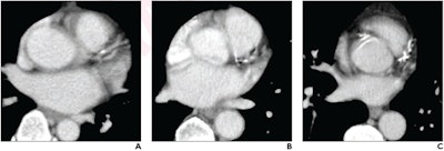 (A) mild, (B) moderate, (C) severe CAC on nongated contrast-enhanced chest image. Image and caption courtesy of the American Journal of Roentgenology.