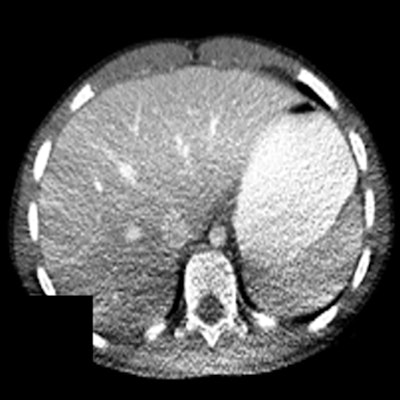 Figure 4. Shading artifacts as a result of beam hardening can be seen on the CT scan in the posterior region of the patient, causing an artifactual change in liver density. Reproduced from Szczykutowicz et al.7