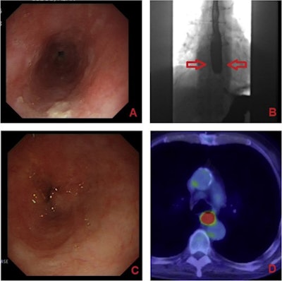 Barium swallow studies in practice: A 71-year-old male first presented with retrosternal pain and dysphagia. The initial esophagogastroduodenoscopy (A) had a histological diagnosis of tubular adenoma. The barium swallow showed mild dysmotility and hold-up in the distal esophagus (B, pointed to by the red arrows). A normal-appearing esophagus was shown on CT three months later, but a repeat EGD was performed six months later due to progressive dysphagia, which showed 'suspicious appearing fibrotic stenosis in mid-distal esophagus' (C) with squamous cell carcinoma demonstrated on histology. This was then confirmed on F-18 FDG PET/CT staging as an FDG avid carcinoma in the mid-distal esophagus (D). Image courtesy of Clinical Radiology.