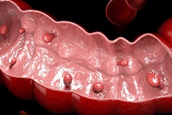 2020 10 28 23 49 6025 Colon Polyps 400