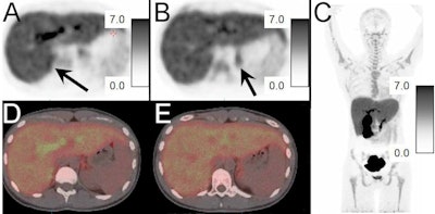 PET/CT images of FNP-59 in a 21-year-old female without adrenal pathology and pretreated with cosyntropin given prior to 6 mCi of F-18 FNP-59. Axial PET images obtained three hours after injection of the upper abdomen with adrenal glands (black arrows) identified on the right (A) and left (B). Scale bars are 0-7 SUV. Adrenal-to-liver ratio at ~1.3:1 on the right and 1:1.1 on the left at three hours. Fused PET/CT images of the adrenal glands are also shown (D, E) along with maximum intensity pixel image (C) that demonstrates expected gallbladder/biliary/bowel uptake given bile secretion. Image courtesy of the Journal of Nuclear Medicine.