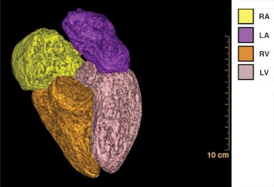 3D visualizations of cardiac chamber based on segmentation of chambers on CT pulmonary angiography (CTPA) in a 57-year-old woman with pulmonary hypertension. CTPA image shows enlargement of right heart, particularly of right atrium. RA = right atrium, LA = left atrium, RV = right ventricle, LV = left ventricle. Image and caption courtesy of the American Journal of Roentgenology.