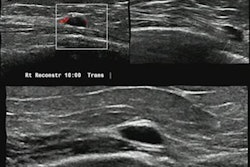 2022 05 02 22 28 7286 2022 05 02 Arrs Ultrasound Lobular Cancer 20220502220732