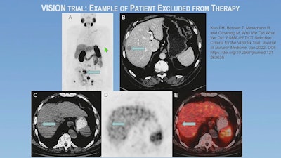 An example of a patient excluded by imaging selection criteria used in the VISION trial. (A) Anterior maximum-intensity projection from Ga-68 PSMA-11 PET/CT has readily evident PSMA-positive disease, for example, in the sacrum (arrow); thus, the next step is to evaluate the diagnostic CT scan for lesions that fulfill size criteria for possible exclusion. (B) On contrast-enhanced diagnostic CT, a 1.8-cm metastasis is identified in the right hepatic lobe (arrow). Trans-axial low-dose CT (C), PET (D), and fused PET/CT (E) images show that the metastasis (arrows) has activity similar to normal liver, is therefore PSMA-negative, and would result in exclusion. Level of uptake in the hepatic metastasis was importantly confirmed in sagittal and coronal planes (not shown) in case of misregistration.