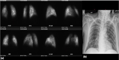 A 76-year-old patient positive for COVID-19. (A) Lung perfusion scintigraphy shows near-homogeneous tracer distribution in both lungs. No distinct segmental perfusion defect is noted. The case was classified as a low-probability scan for pulmonary embolism. (B) Chest radiograph shows patchy ground-glass opacities of both lungs in peripheral distribution.