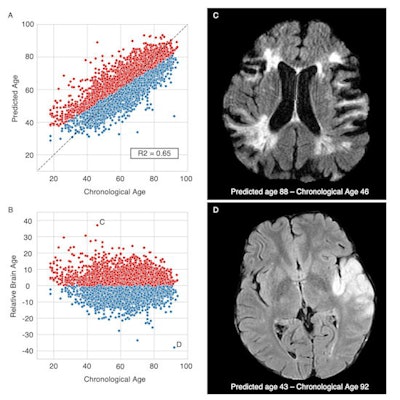 Brain age prediction performances and relative brain age. Scatter plots of the T2-FLAIR radiomics (A) predicted brain age and (B) relative brain age (RBA) per chronological age. Patients were colored in red if they had a positive RBA, so a brain that appeared 'older' to their age-matched peers, or in blue if they had a negative RBA and a 'younger' looking brain. (C) T2-FLAIR axial image of a patient with a positive RBA: predicted brain age = 88, chronological age = 46, RBA = 36.2; this patient's brain exhibits multiple cortical and subcortical sequelae, moderate to severe parenchymal atrophy with enlarged ventricles and sulci, and confluent white matter hyperintensities, which extents are unexpectedly large for a 46-year-old patient. (D) T2-FLAIR axial image of a patient with a negative RBA: predicted brain age = 43, chronological age = 92, RBA = -38.6; notwithstanding the left middle cerebral artery lesion, this patient's brain trophicity is maintained, the cortex and the deep gray nuclei are sharply defined, overall describing a healthy brain for this 92-year-old patient. Courtesy of Dr. Martin Bretzner and ESOC 2022.